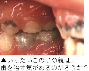 乳歯