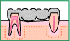 固定式入れ歯