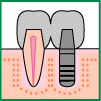 インプラント治療